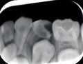 Leczenie endodontyczne zębów mlecznych