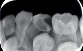 Leczenie endodontyczne zębów mlecznych