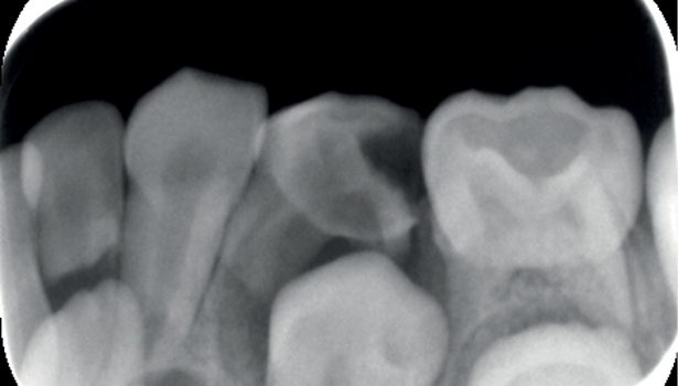 Leczenie endodontyczne zębów mlecznych