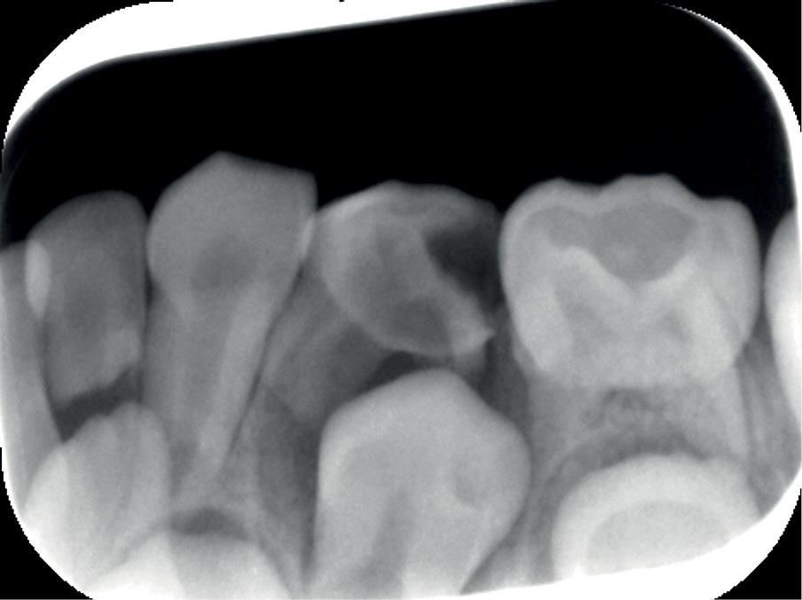 Leczenie endodontyczne zębów mlecznych