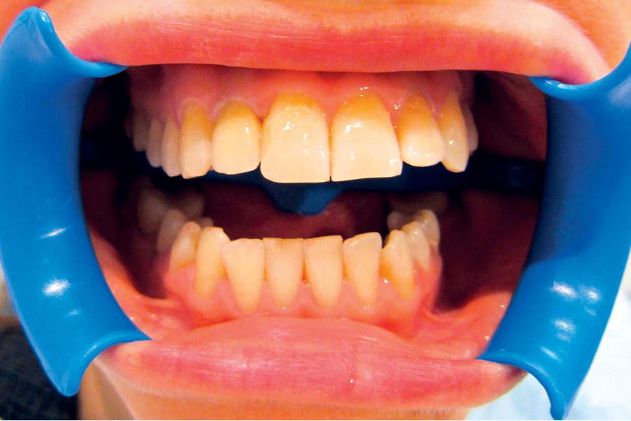 EWP_3_17_NATYCHMIASTOWA_ODBUDOWA_ZEBA_12_PO_LECZENIU_KANALOWYM_RYC_13