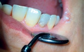 Natychmiastowa odbudowa zęba