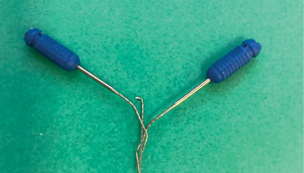 Usuwanie złamanych instrumentów endodontycznych