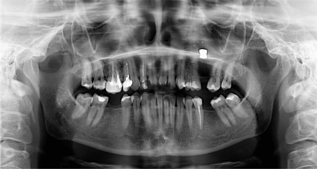 TPS_1-2_17_chirurgia_stomatologiczna_CIALO_OBCE_W_ZATOCE_SZCZEKOWEJ_FOT_1