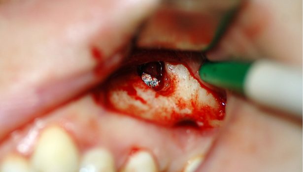 TPS_1-2_17_chirurgia_stomatologiczna_CIALO_OBCE_W_ZATOCE_SZCZEKOWEJ_FOT_4