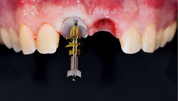 TPS_1-2_17_protetyka_ESTETYKA_W_PRZEDNIEJ_CZESCI_SZCZEKI_FOT_7_B
