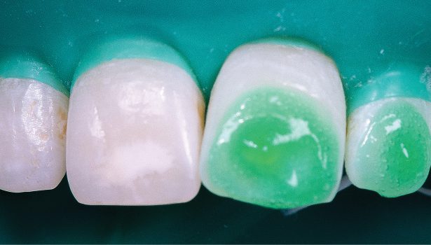 TPS_1-2_17_sprzet_i_materialy_INFILTRACJA_PLYNNA_ZYWICA_FOT_3