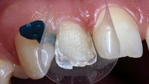 TPS_1-2_17_stomatologia_zachowawcza_JAK_POPRAWIC_ADHEZJE_I_RETENCJE_W_TRUDNYCH_WARUNKACH_CZ_I_FOT_5