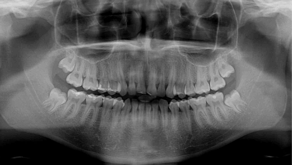 TPS_1-2_17_stomatologia_zachowawcza_ODBUDOWA_ZEBOW_SIECZNYCH_USZKODZONYCH_W_WYNIKU_URAZU_FOT_2