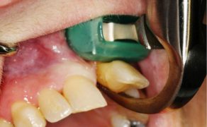 ekstrakcje zębów