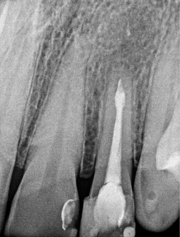 TPS_9_20_temat_numeru_LECZENIE_ENDODONTYCZNO_CHIRURGICZNE_SIEKACZA_BOCZNEGO_FOT_3