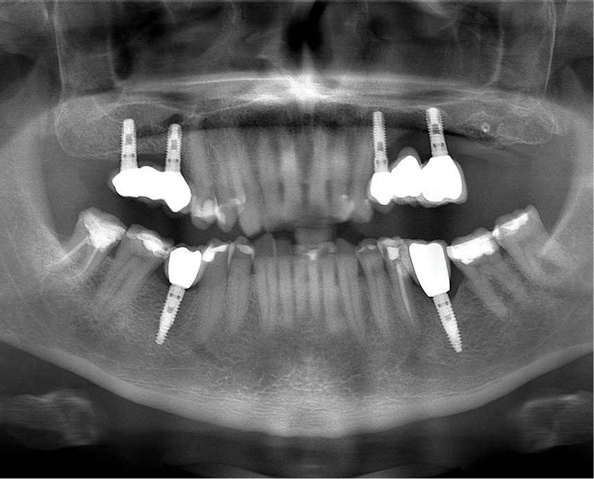 TPS_9_20_periodontologia_LECZENIE_PERIIMPLANTITIS_IMPLANTOPLASTYKA_LASER_DIODOWY_FOT_1