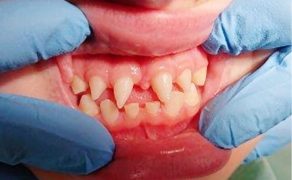 Odbudowa kompozytowa zębów stożkowych