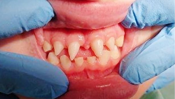 Odbudowa kompozytowa zębów stożkowych