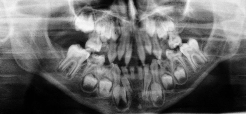 TPS_9_20_ortodoncja_ODBUDOWA_KOMPOZYTOWA_ZEBOW_STOZKOWYCH_DZIECKO_HIPODONCJA_FOT_2
