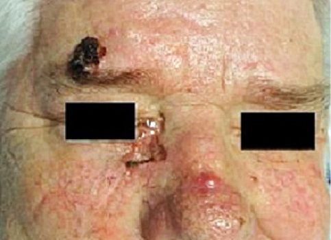 Rak podstawnokomórkowy