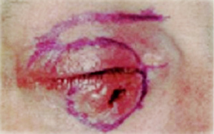 TPS_9_20_chirurgia_i_implantologia_RAK_PODSTAWNOKOMORKOWY_SKORY_PRZYSRODKOWEGO_KATA_OKA_FOT_4