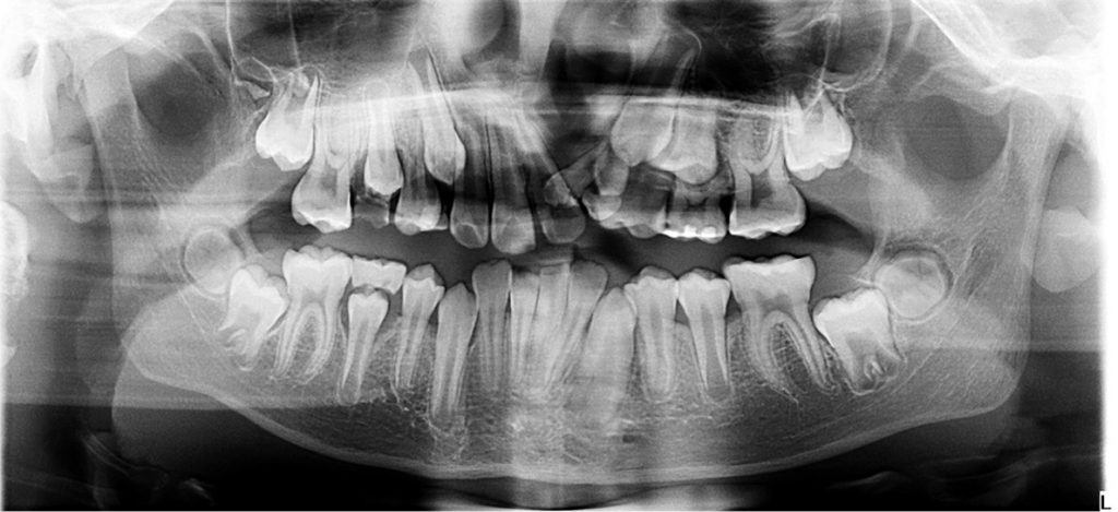 Rozszczep podniebienia