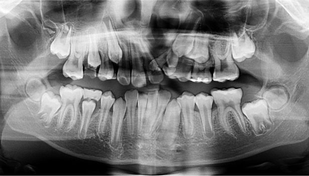 Rozszczep podniebienia
