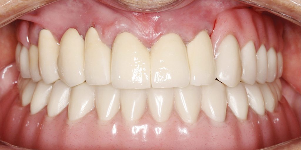 TPS_9_20_protetyka_dysfunkcje_narzadu_zucia_ZASTOSOWANIE_ELEMENTOW_PRECYZYJNYCH_W_LECZENIU_PROTETYCZNYM_FOT_6