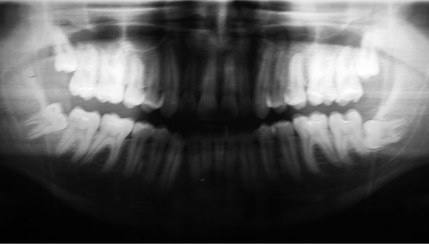 Skojarzone leczenie zębiaka szczęki