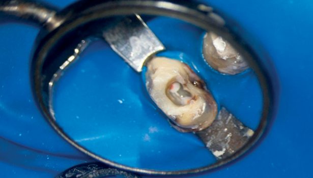 Usunięcie złamanej igły LENTULO