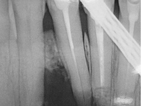 chirurgiczne leczenie rozległych zmian