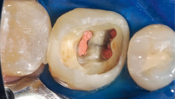 Uzupełnienie monolityczne