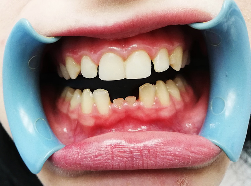 brak zawiązków siekaczy