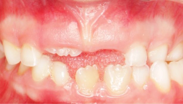 dodatkowy ząb sieczny