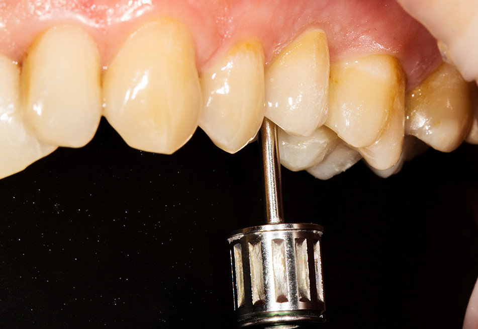 TPS_10_20_chirurgia_stomatologiczna_INDYWIDUALNA_SRUBA_FOT_21