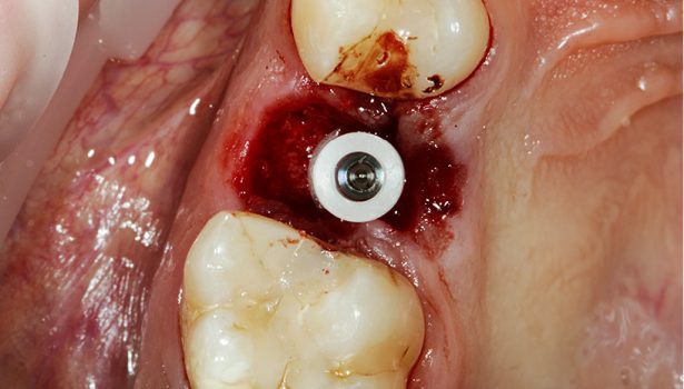 Indywidualna śruba gojąca