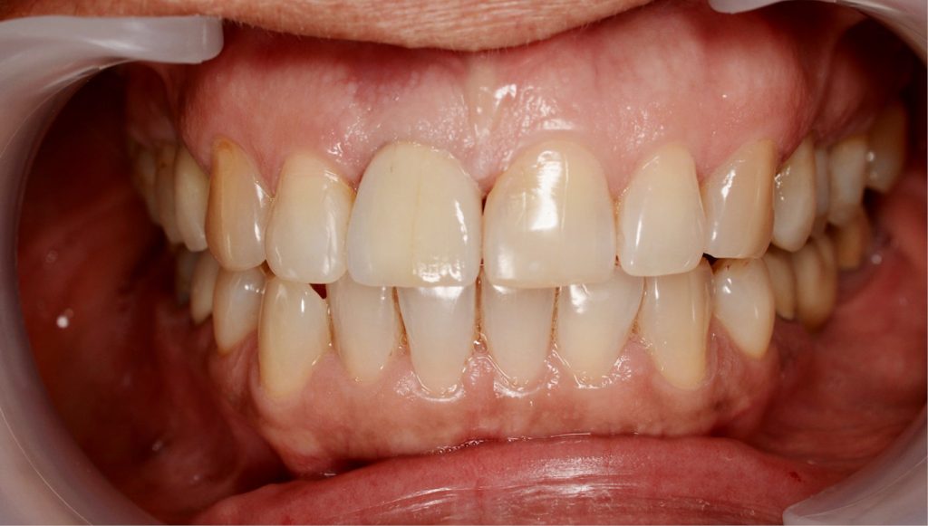 TPS_10_20_chirurgia_implantologia_KSZTALTOWANIE_PROFILU_FOT_12