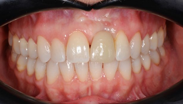 Kształtowanie profilu wyłaniania