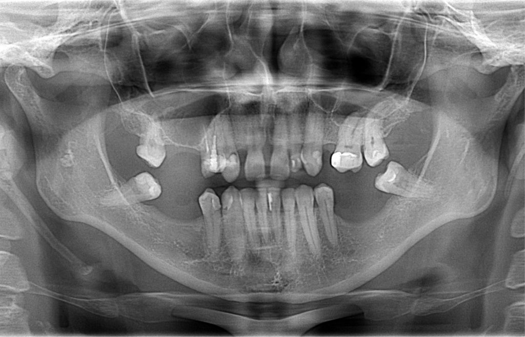 Pacjent z zespołem Eagle’a