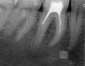 powtórne leczenie endodontyczne