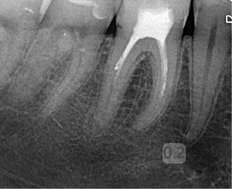 powtórne leczenie endodontyczne