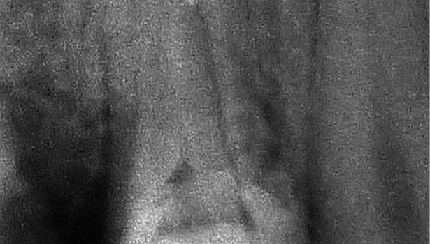 Usuwanie złamanych narzędzi