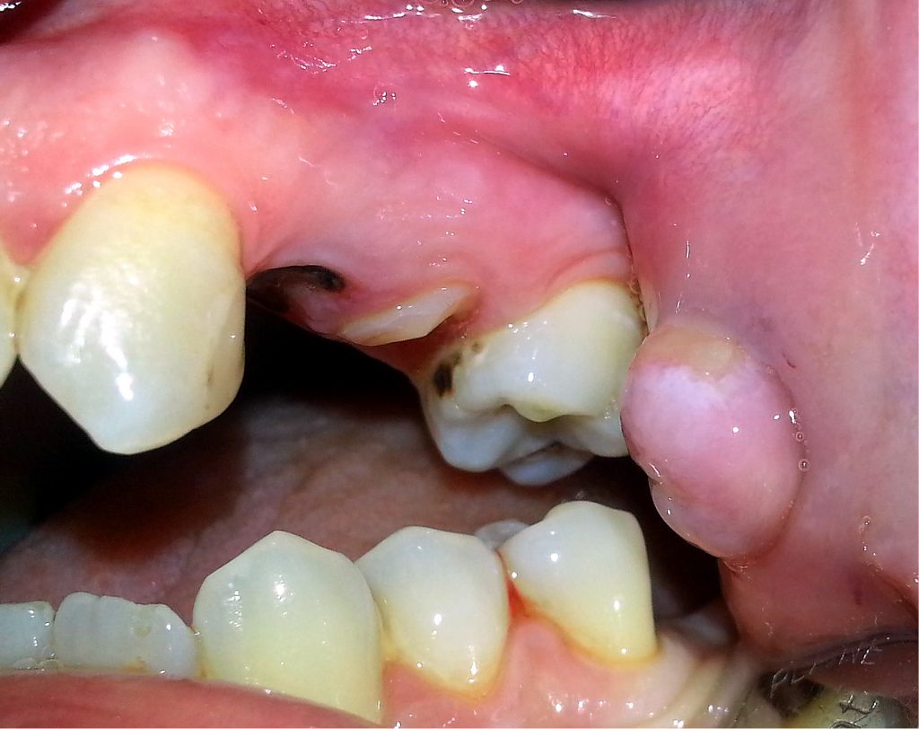 Leukoplakia