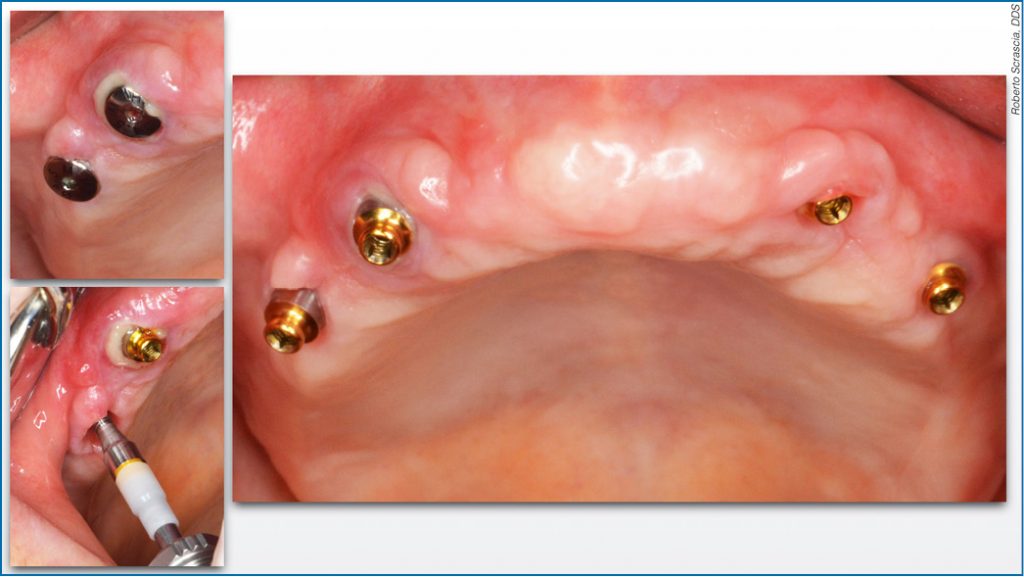 TPS_12_16_protetyka_REHABILITACJA_PROTETYCZNA_SZCZEKI_FOT_10