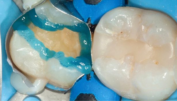 wypełnienia zębów bocznych