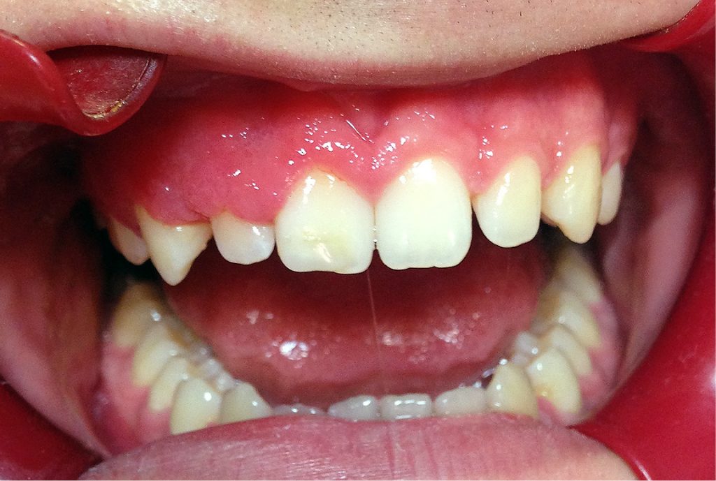 Zmiany w obrębie błony śluzowej