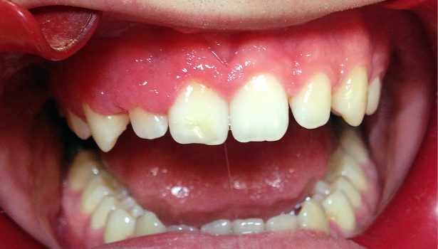 Zmiany w obrębie błony śluzowej