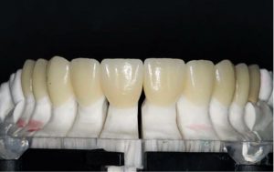 Fot. 8a gotowe licówki na podzielonym modelu; fot. archiwum autorów