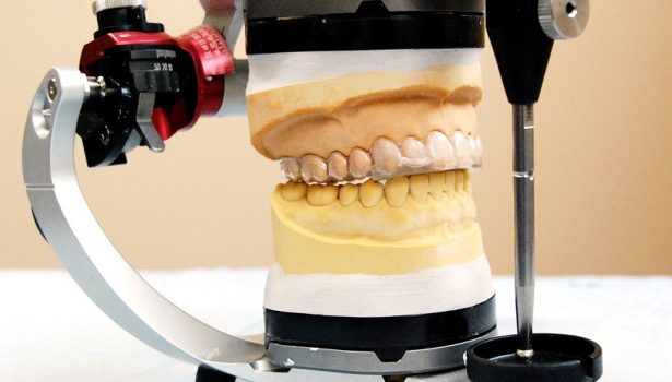 Fot. 6. Płytka MMD wg Barona po wykonaniu w laboratorium protetycznym; fot. archiwum autorów