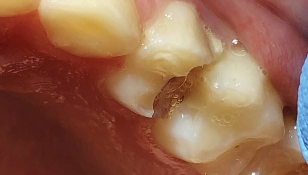 Ekstrakcja zęba mlecznego