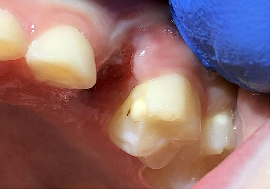 TPS_11-12_20_stomatologia_wieku_rozwojowego_EKSTRAKCJA_ZEBA_MLECZNEGO_FOT_4