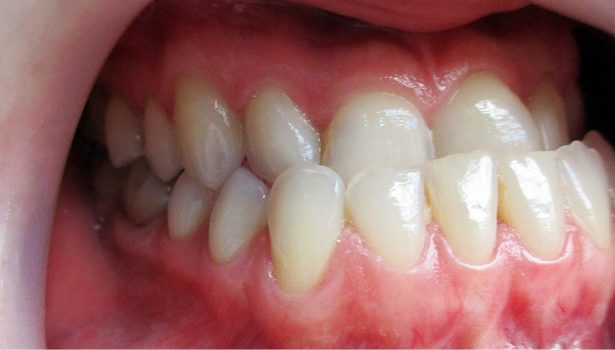 Kompromisowe interdyscyplinarne leczenie wady kostnej