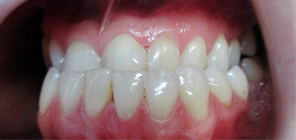 TPS_11-12_20_ortodoncja_KOMPROMISOWE_INTERDYSCYPLINARNE_LECZENIE_WADY_KOSTNEJ_FOT_9