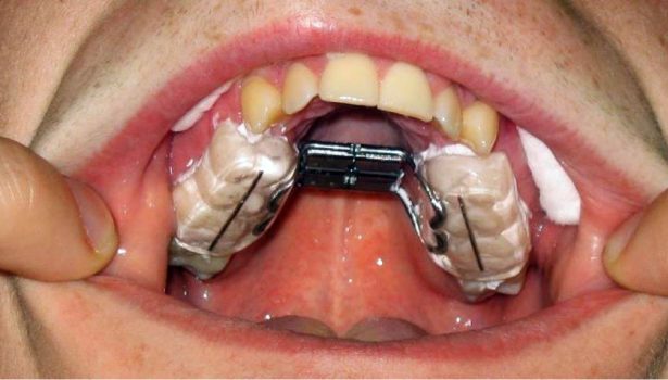 TPS_11-12_20_stomatologia_wieku_rozwojowego_METODY_LECZENIA_ZGRYZU_OTWARTEGO_FOT_1_A